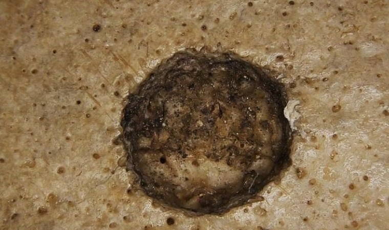 Kanserle Mücadelede Antik Mısırlıların Cerrahi İşlemleri