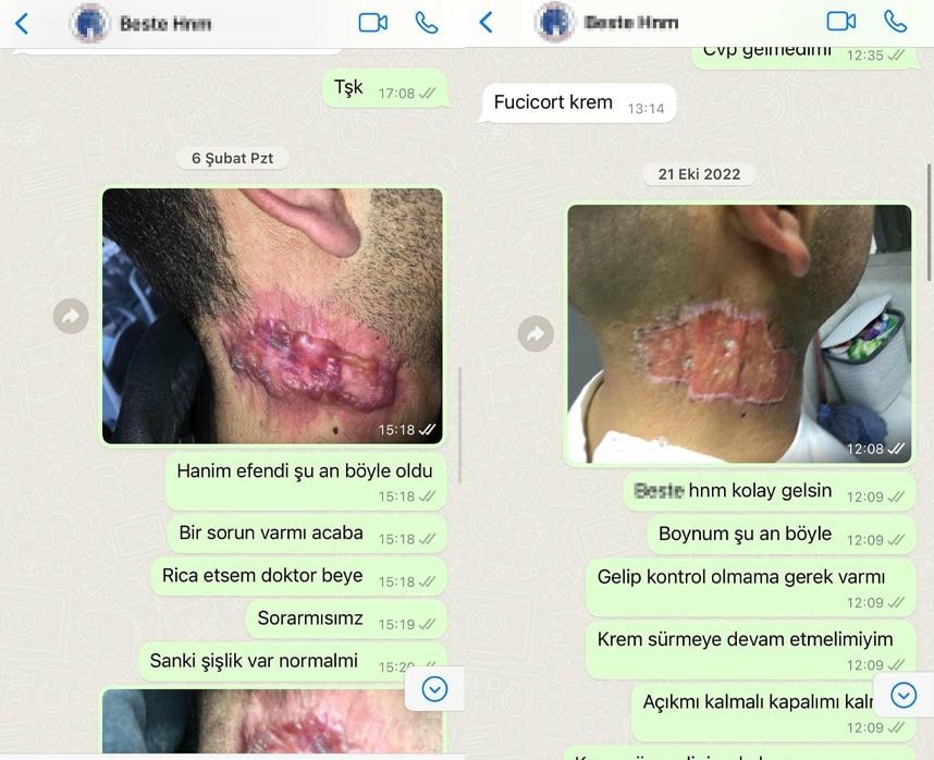Suat Barman'ın Yanık İzi Macerası ve Hukuki Süreci