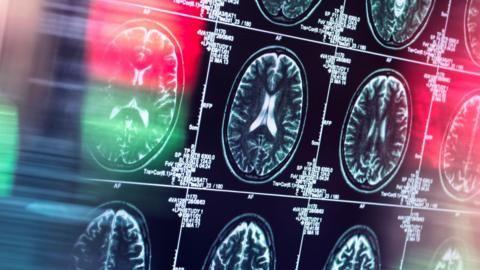Lecanemab ve Alzheimer Üzerindeki Etkileri