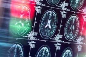 lecanemab-ve-alzheimer-etkileri-ve-saglik-riskleri-RGQmv5Y8.jpg