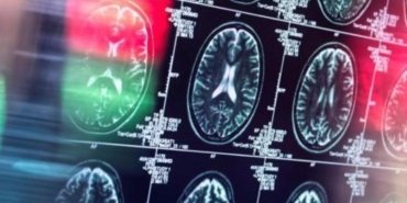 lecanemab-ve-alzheimer-etkileri-ve-saglik-riskleri-RGQmv5Y8.jpg