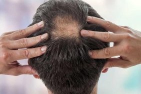 sac-dokulmesi-hakkinda-dermatoloji-uzmani-dr-elcin-akdasin-onemli-bilgileri-DmN1Yhhh.jpg