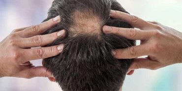 sac-dokulmesi-hakkinda-dermatoloji-uzmani-dr-elcin-akdasin-onemli-bilgileri-DmN1Yhhh.jpg