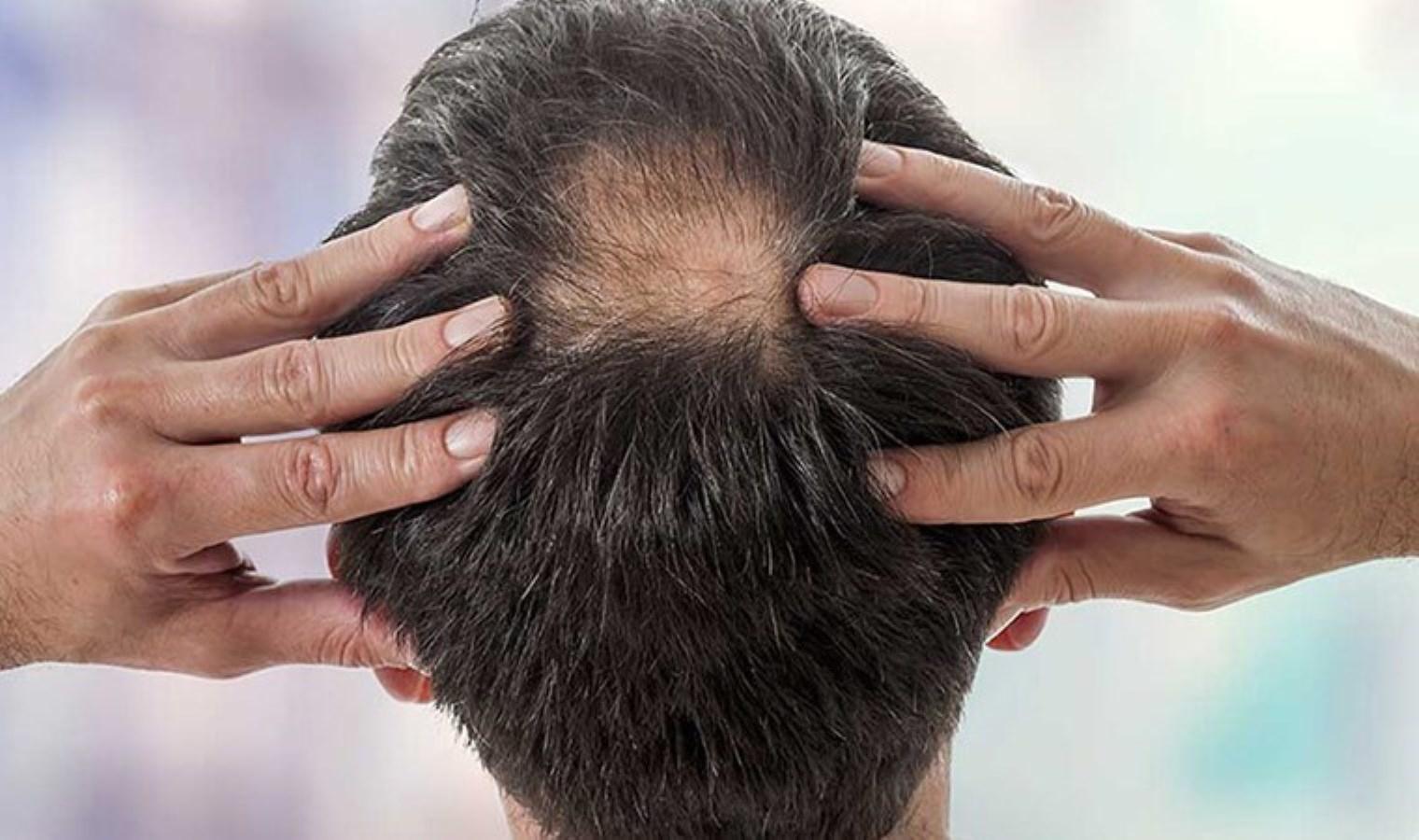 sac-dokulmesi-hakkinda-dermatoloji-uzmani-dr-elcin-akdasin-onemli-bilgileri-DmN1Yhhh.jpg