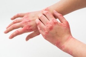atopik-dermatit-hastalarinin-yaz-aylarinda-dikkat-etmesi-gerekenler-BY77Opt5.jpg