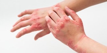 atopik-dermatit-hastalarinin-yaz-aylarinda-dikkat-etmesi-gerekenler-BY77Opt5.jpg