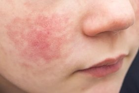 parvovirus-b19-belirtileri-riskleri-ve-onleme-yontemleri-Upf5JWNA.jpg