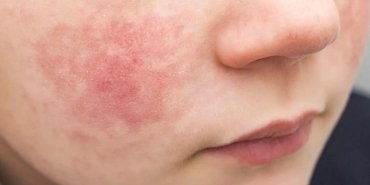 parvovirus-b19-belirtileri-riskleri-ve-onleme-yontemleri-Upf5JWNA.jpg
