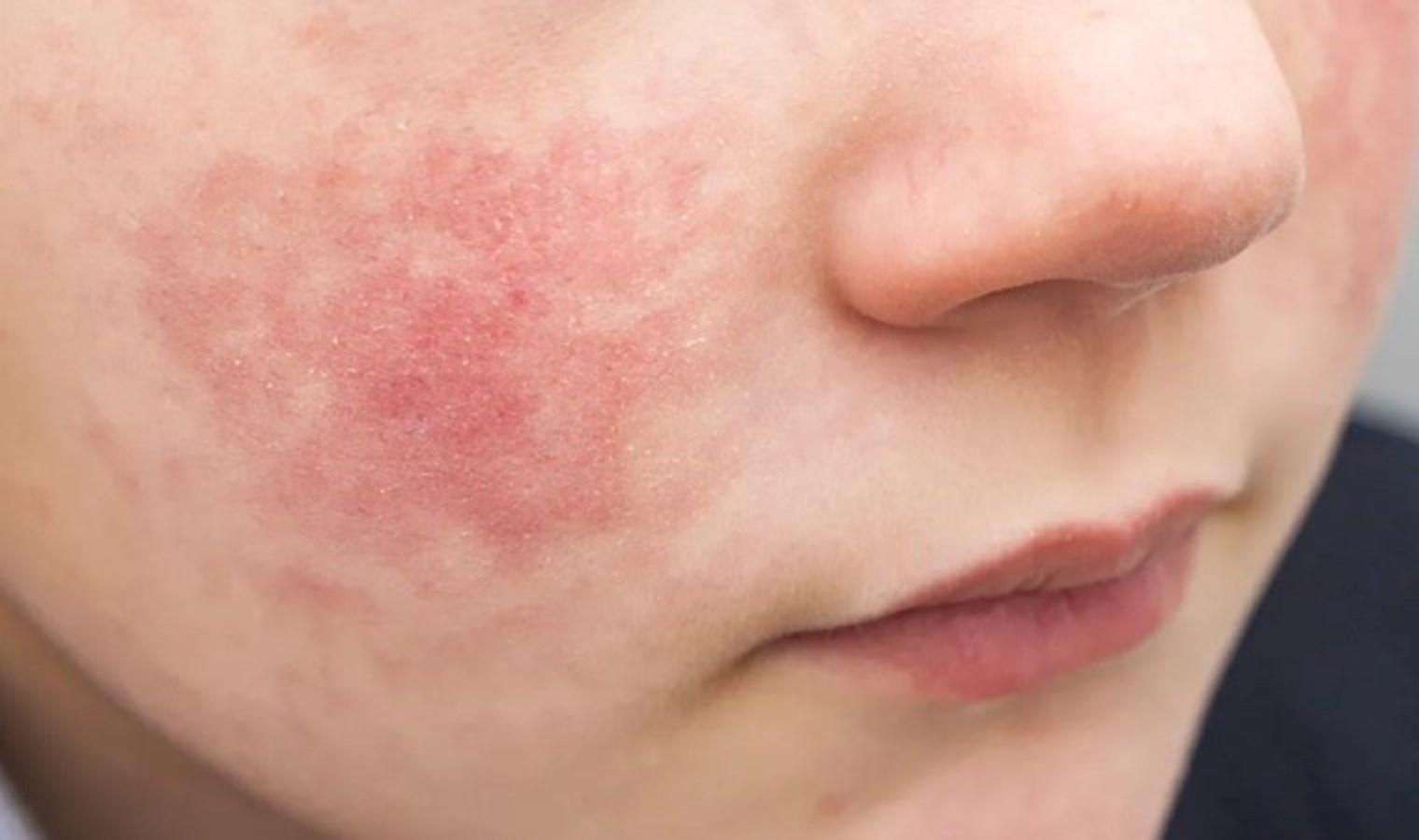 parvovirus-b19-belirtileri-riskleri-ve-onleme-yontemleri-Upf5JWNA.jpg