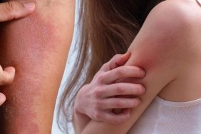 dermatoloji-uzmanindan-onemli-uyari-kasinti-ve-kizariklik-belirtilerine-dikkat-abGUv3bS.jpg