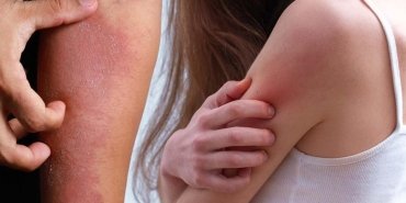 dermatoloji-uzmanindan-onemli-uyari-kasinti-ve-kizariklik-belirtilerine-dikkat-abGUv3bS.jpg