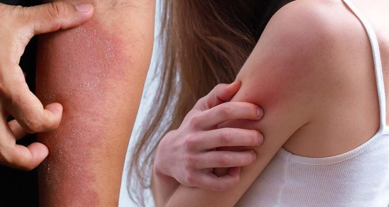 dermatoloji-uzmanindan-onemli-uyari-kasinti-ve-kizariklik-belirtilerine-dikkat-abGUv3bS.jpg