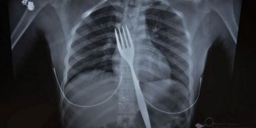 rontgende-ortaya-cikti-doktoru-bile-sasirtti-yuttugu-18-santimlik-catal-ameliyatla-alindi-irWh7gt5.jpg