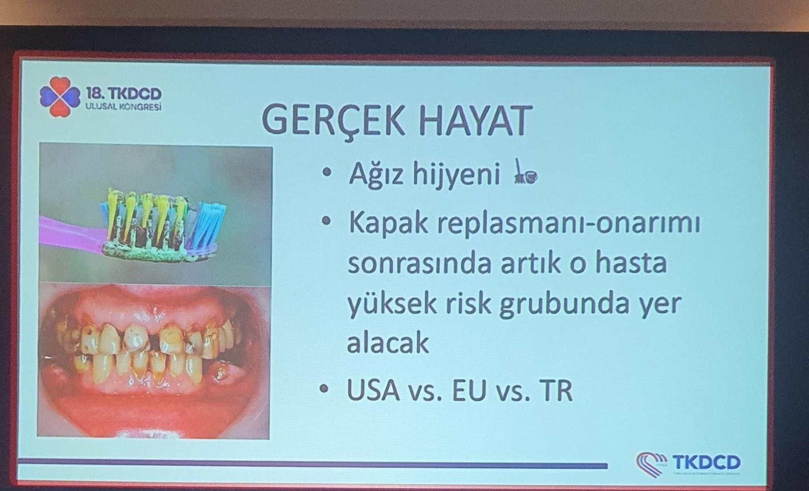 Kalp Kapak Hastalıklarında Ağız Hijyeninin Önemi