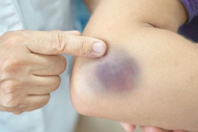 kolay-morarma-lipodem-belirtisi-olabilecegini-bilin-tAXU7huH.jpg