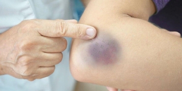 kolay-morarma-lipodem-belirtisi-olabilecegini-bilin-tAXU7huH.jpg