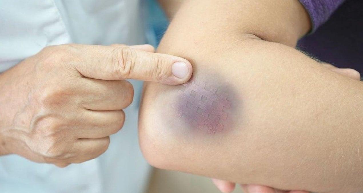 kolay-morarma-lipodem-belirtisi-olabilecegini-bilin-tAXU7huH.jpg