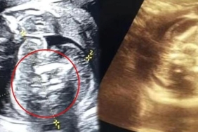 saskinlik-yaratan-olay-yeni-dogan-bebekten-iki-fetus-cikti-x5pmbgCL.jpg