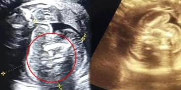 saskinlik-yaratan-olay-yeni-dogan-bebekten-iki-fetus-cikti-x5pmbgCL.jpg