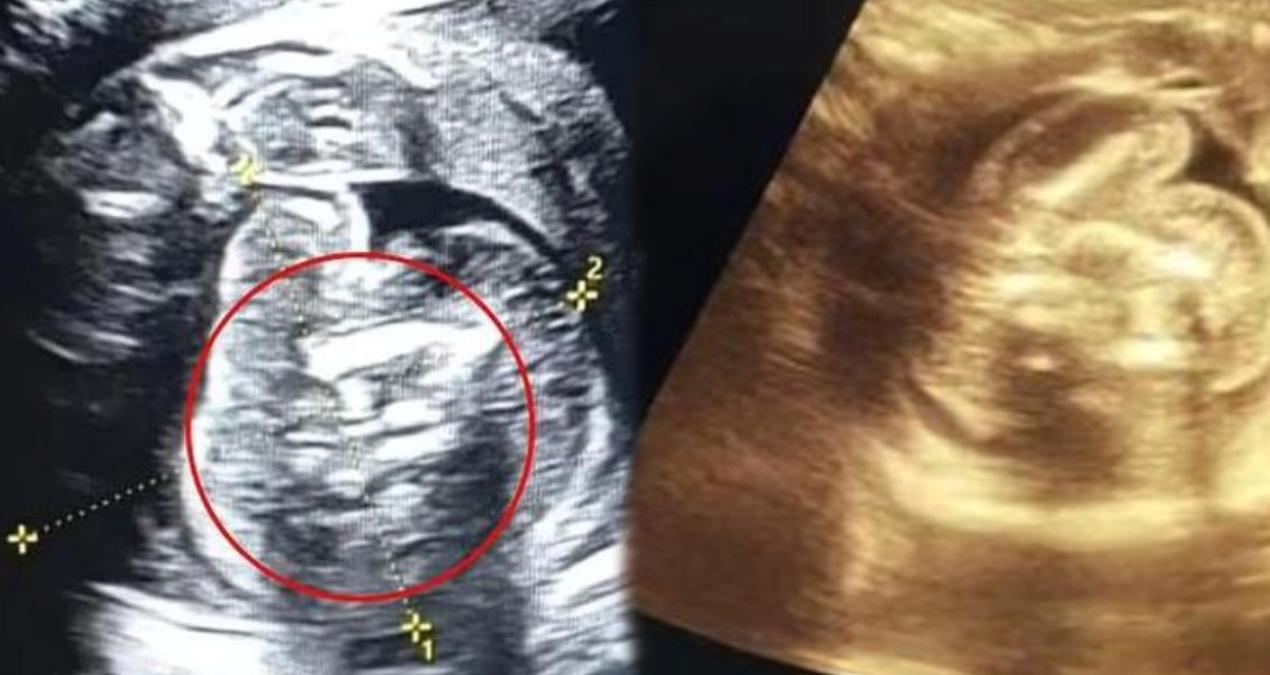 saskinlik-yaratan-olay-yeni-dogan-bebekten-iki-fetus-cikti-x5pmbgCL.jpg