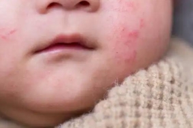 besin-alerjilerine-dikkat-anne-sutuyle-bile-gecebiliyor-web-icin-ozgun-baslik-hm4PMs4p.jpg