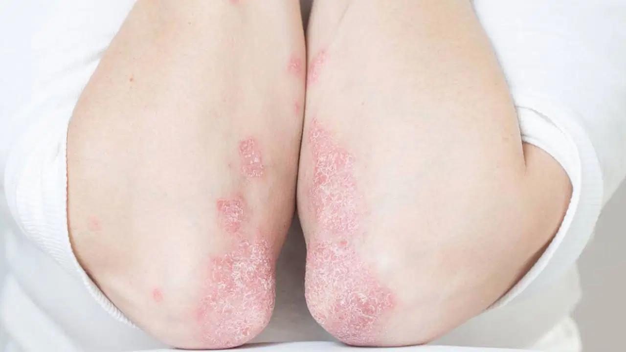 kadinlarda-lupus-bagisiklik-sistemine-yonelik-hastaliklarin-9-kat-daha-yaygin-gorulmesi-EIwx2S7n.jpg