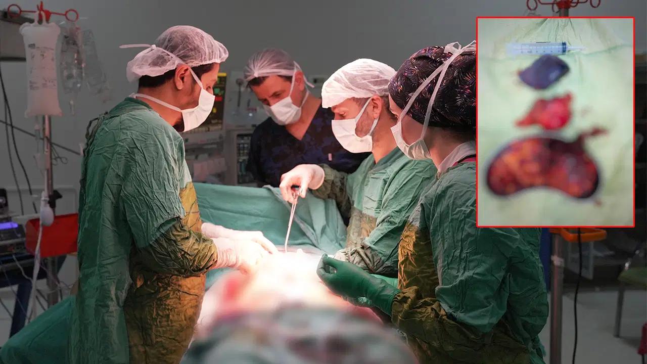 karnindaki-siskinlik-sikayetiyle-hastaneye-basvuran-kisiden-2-kilo-200-gram-agirliginda-tumor-cikarildi-4G5Dk5bz.jpg