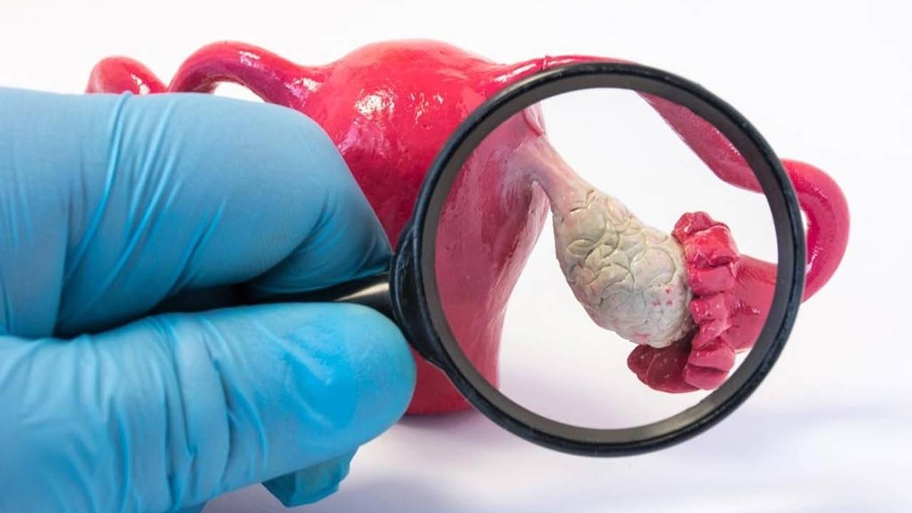her-10-kadindan-biri-gizli-sorunu-aciga-cikariyor-endometriozis-nedir-R9OLc64Y.jpg